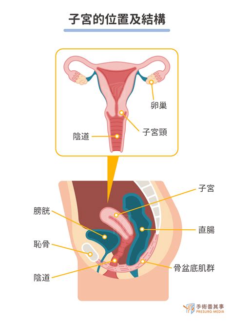 子宮脫垂會好嗎？原因、檢查、等級、治療、手術後遺症一次看