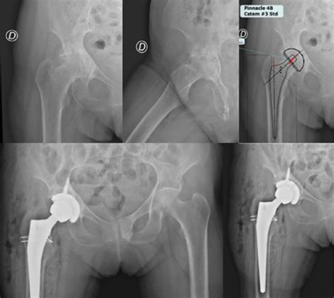 Planificaci N Preopratoria De Paciente Con Protrusio Acetabular