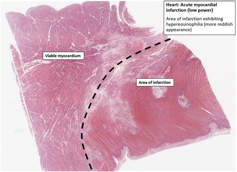 Heart Myocardial Infarct Nus Pathweb Nus Pathweb