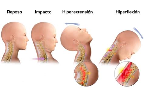Latigazo Cervical Tratamiento Terapias Craneosacral En Vilafranca Del