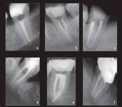 Representative Radiographs Of The Different Canal Configurations Of