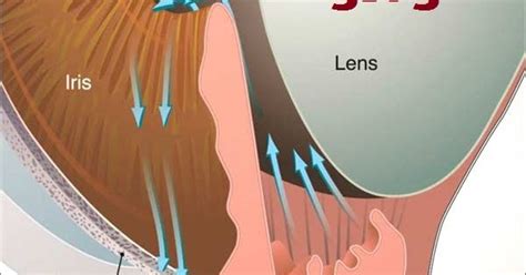 Glaucoma Specialist Blog The Glog