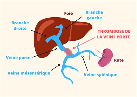 Interview Du Dr Aur Lie Plessier Etude Riport Rivaroxaban Mg