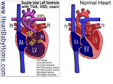 42 Double Inlet Left Ventricle With Tga Vsd Coarc A Photo On Flickriver