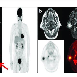 Lymph Node Metastases In Two Patients With Nasopharyngeal Carcinoma