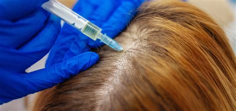 Prp Vs Prf For Hair Loss Which Is The Better Treatment Face Med Store