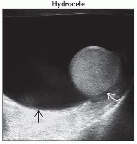 Da Db Extratesticular Cystic Mass Ffu Abdominal Key