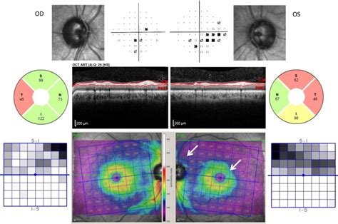 Optic neuropathy secondary to treponemal infection. Optic nerve images ...