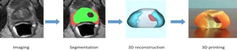 3d Printed Model Of The Prostate Tumor Red Nvb Orange Generated