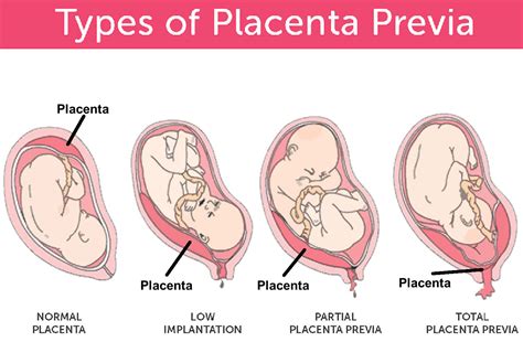 Abruptio Placentae Meaning Causes Symptoms Diagnosis And Management