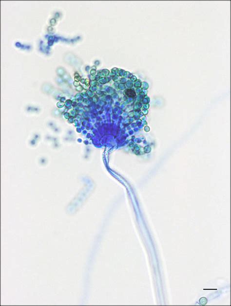 Aspergillus Flavus Infection