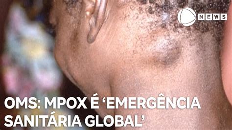 OMS classifica Mpox como emergência sanitária global YouTube