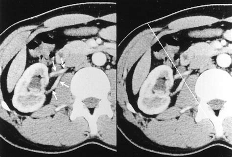 Evaluation Of Crossing Vessels In Patients With Ureteropelvic Junction Obstruction By Means Of