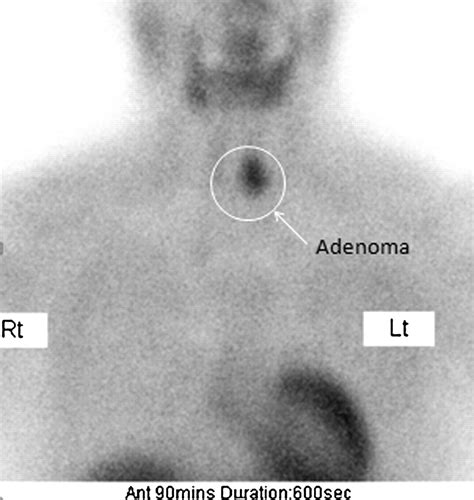 Parathyroid Imaging And Localization Using Spect Ct Initial Results