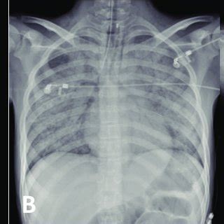 Chest radiography. Chest radiography of (A) the first patient showing ...