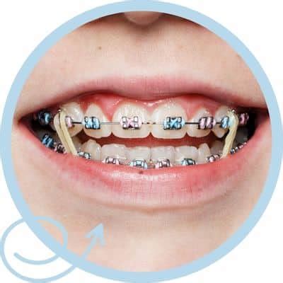 Fun Rubber Band Colors For Braces - PDOC