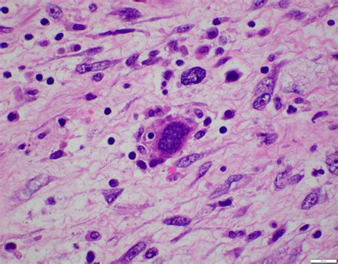 Pathology Outlines Undifferentiated Embryonal Sarcoma