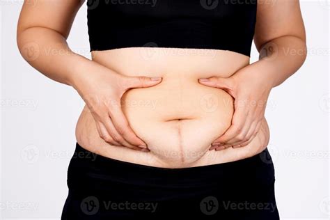 Abdominal Surface Of Fat Woman And Abdominal Stripes On White