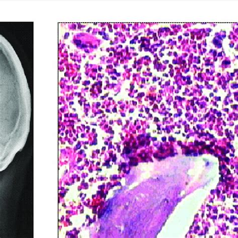 Pdf Osteosclerotic And Osteolytic Lesions In Multiple Myeloma