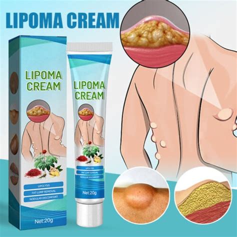 South Moon Lipoma Treatment Ointment Promise Mart