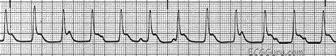 ECG Basics: Accelerated Junctional Rhythm Overriding Normal Sinus Rhythm | ECG Guru - Instructor ...