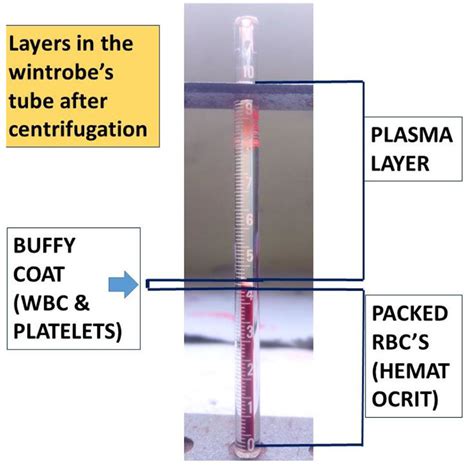 Esr Erythrocyte Sedimentation Rate Focus Dentistry