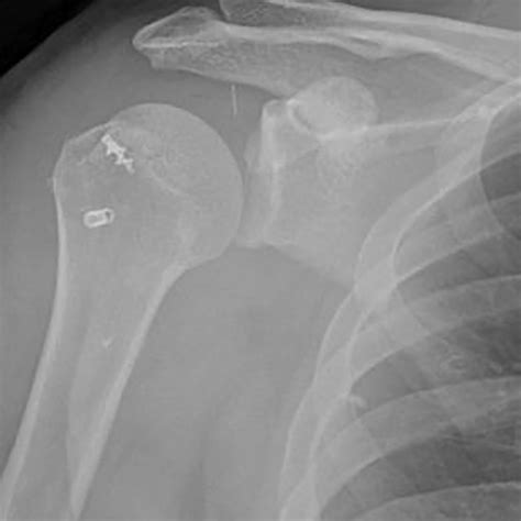 A Rare Injury To A Rear Seat Passenger Bilateral Fracture Dislocation