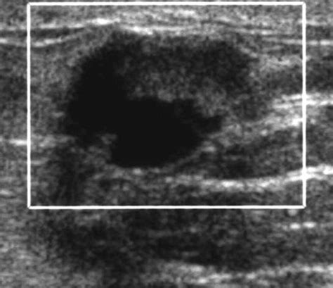 Complex Cystic Breast Masses Diagnostic Approach And Imaging Pathologic Correlation Radiographics