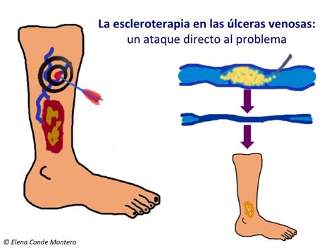 Diagrama De úlcera Venosa