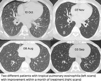 Tropical Pulmonary Eosinophilia Ct Chest Review