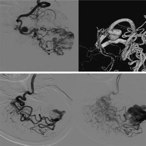 A Digital Subtraction Angiograms Of The Left Internal Carotid Artery