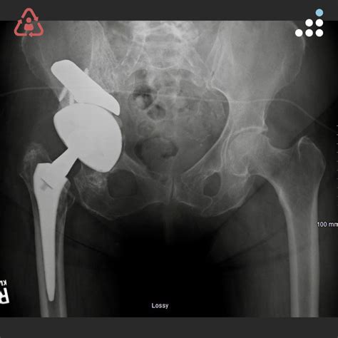 Orthobullets On Twitter 4 Month Post Operative Image