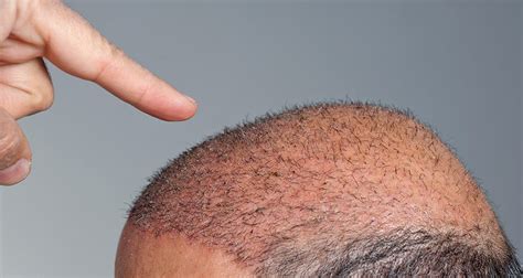 Qu Es La Alopecia Androgen Tica Y A Qui N Afecta Fundaci N Piel