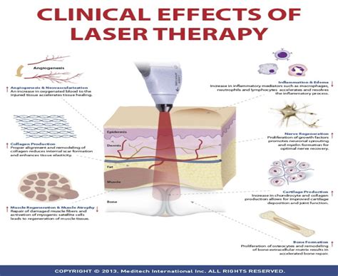 Laser Therapy | Peak Performance