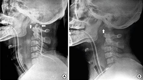 Atlanto Occipital Dislocation A Case Report