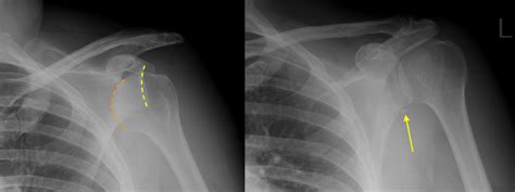 Shoulder dislocation with Bankart fracture - Radiology at St. Vincent's University Hospital