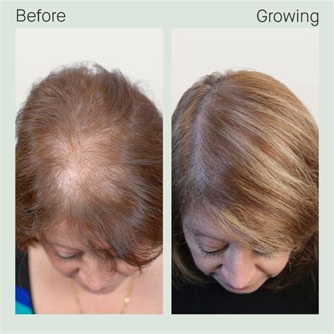 Perich Aesthetics Nutrafol Hair Loss Therapy Near Tampa Clearwater