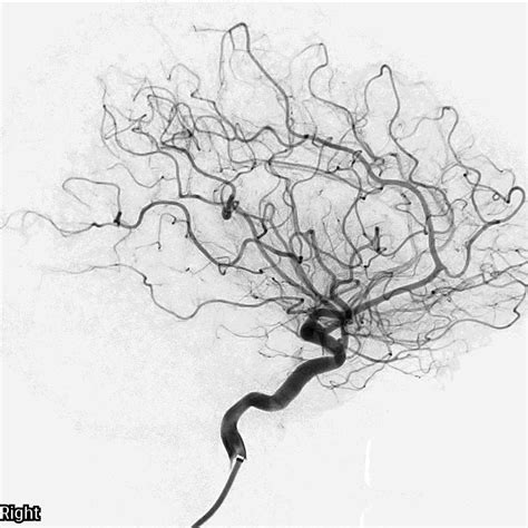 Ruptured Anterior Communicating Artery Aneurysm With Neurogenic