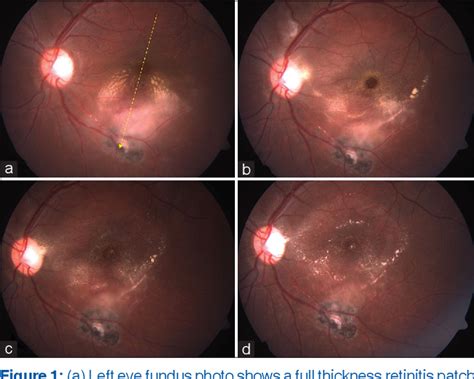 Figure From Spontaneous Closure Of Macular Hole In A Case Of