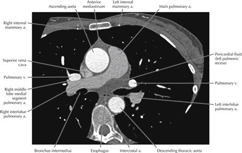 Cardiac Anatomy Using Ct Radiology Key