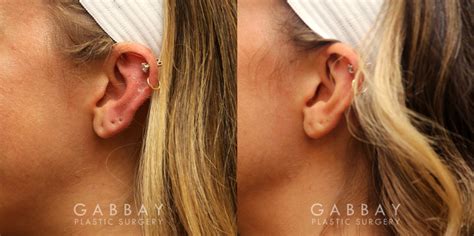 What It S Like Getting Earlobe Repair Surgery Ear Hole Repair Without