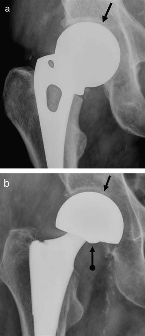 Imaging Of Hip Arthroplasty European Journal Of Radiology