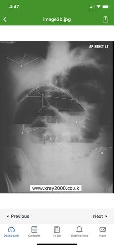 AP Upright Abdomen LAB QZ 9 Flashcards Quizlet