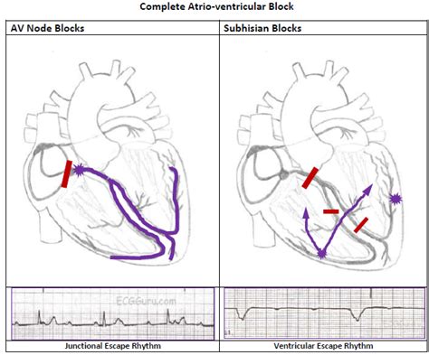 Complete Heart Block Ecg Guru Instructor Resources