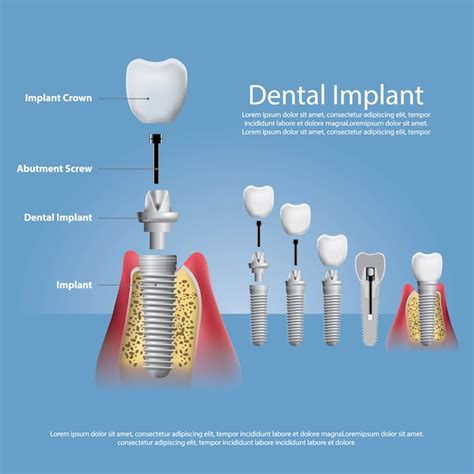 Premium Vector Human Teeth And Dental Implant Illustration