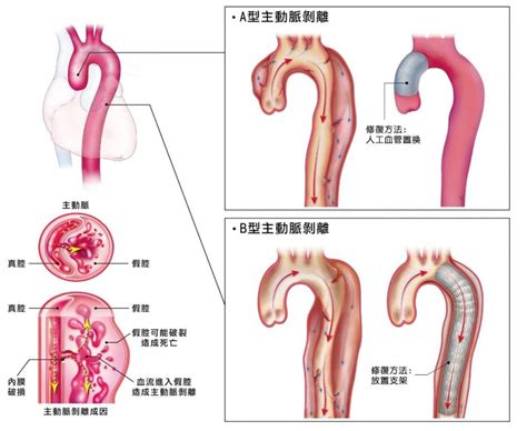 主動脈剝離和遺傳有關 長庚研究：有家族病史發病風險高達682倍 自由健康網