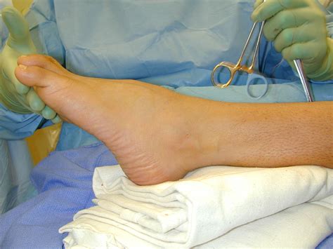 Ankle equinus, Tight achilles , Heel pain, Plantar fasciitis, Heel spurs, Bunions, Hammertoes ...