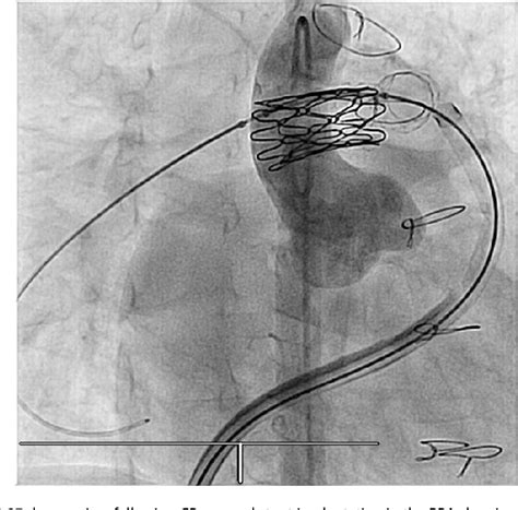 Figure From Iatrogenic Aortopulmonary Fistula After Balloon Dilation