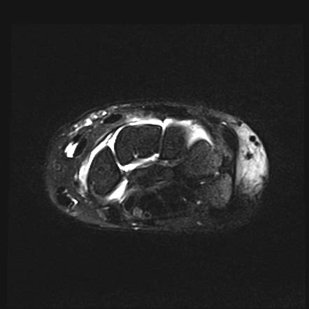 Scapholunate Ligament Disruption Image Radiopaedia Org