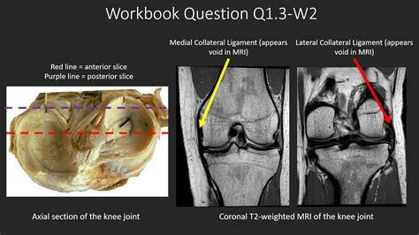 Radiology Quiz 132781 Radiopaedia Org Playlist LQB482 MRI Knee By